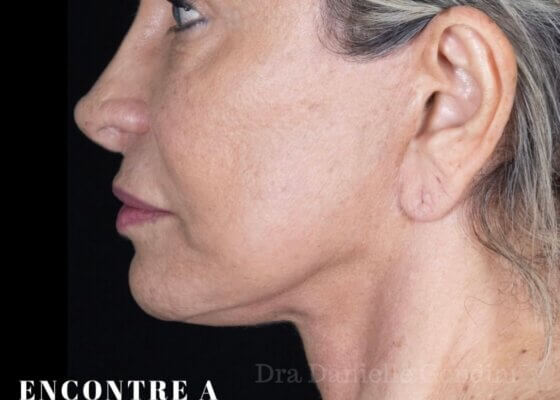 Foto com exemplo de cicatriz